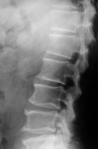 rhumatologie-radiographie-rachis-arthrose-vertebrale-55GMwm4fwb Radiographie montrant de l'arthrose lombaire