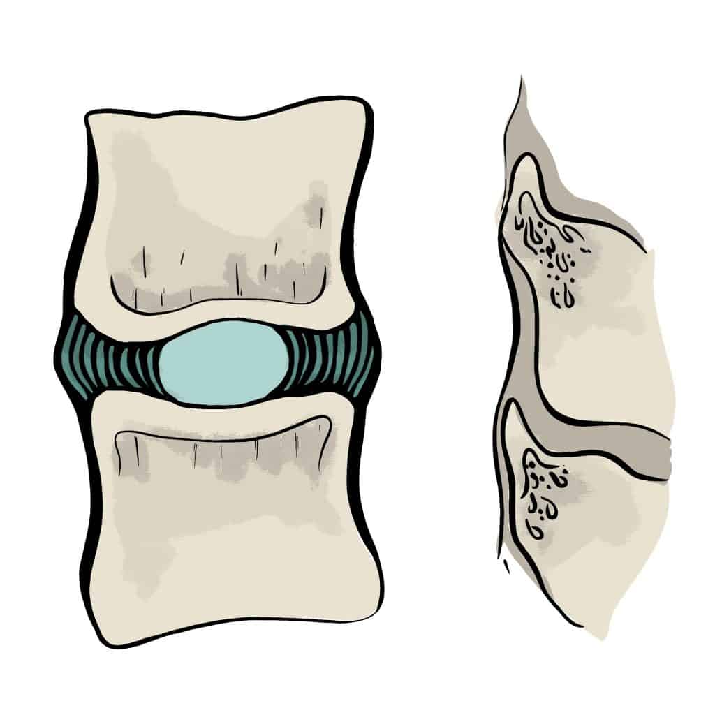 Pincement global Pincement discal intersomatique global