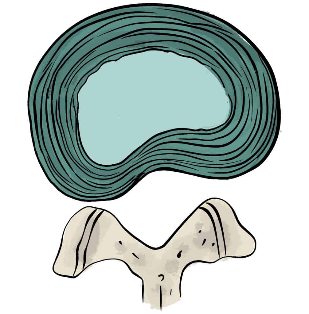 Protrusion discale foraminale Protrusion discale foraminale
