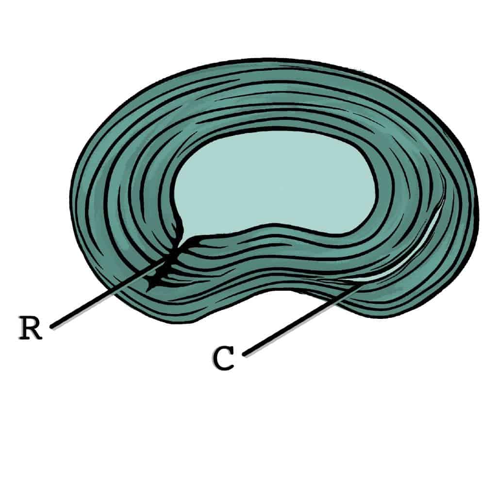 Fissure radiale ou fissure concentrique Fissure radiale ou fissure concentrique